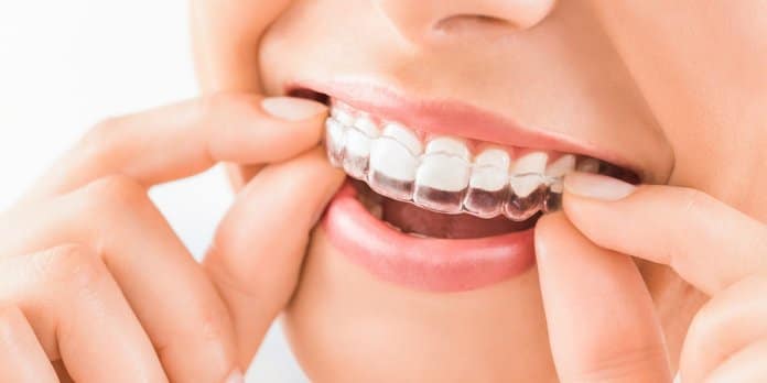 Why Invisalign is so popular