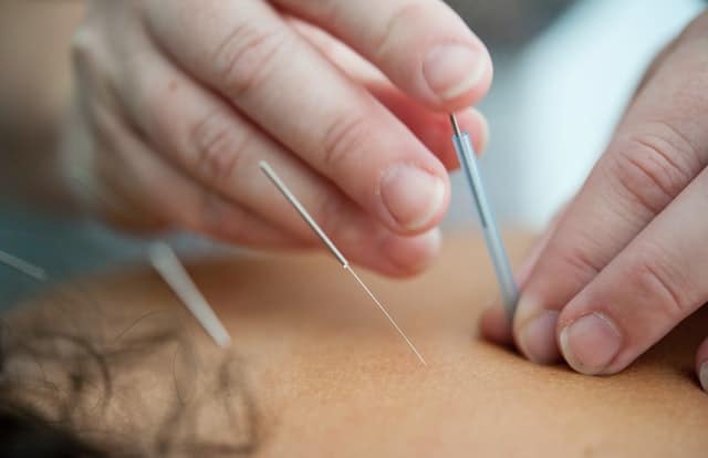 Acupuncture, The Science of Body Healing